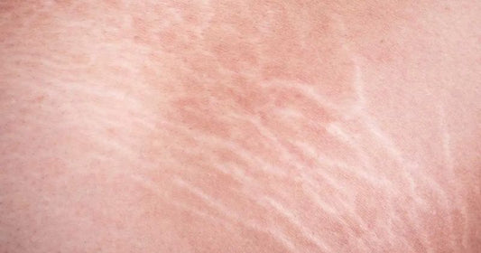 How Do You Get Rid of White Stretch Marks?