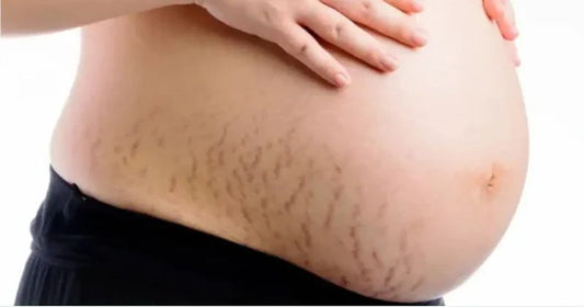 How To Avoid Stretch Marks During Pregnancy Home Remedies?
