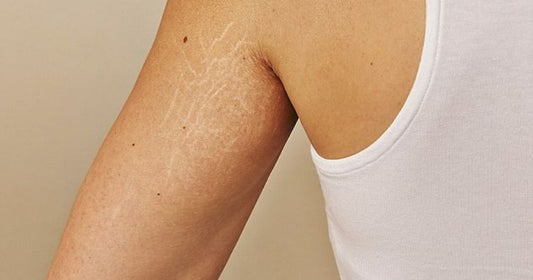 How To Avoid Stretch Marks When Working Out?