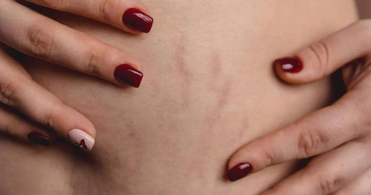 How To Cover Stretch Marks with Makeup?