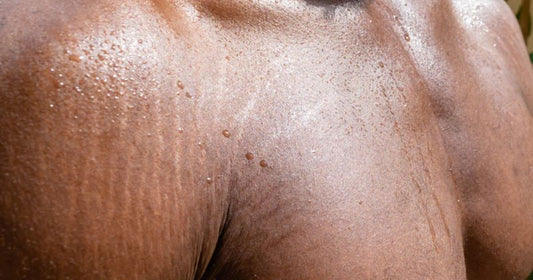How To Get Rid of Stretch Marks for Men?