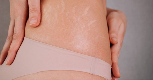How To Heal Stretch Marks Naturally?