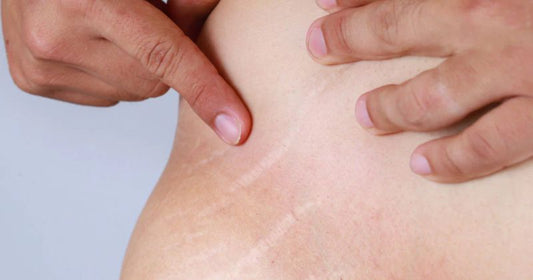 How To Minimize Stretch Marks?