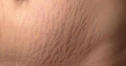 When Do Stretch Marks Appear During Pregnancy?