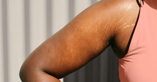 Which Oil Is Best For Stretch Marks?