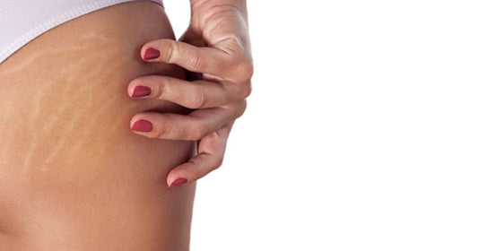 Why Do You Have Stretch Marks On Your Butt?