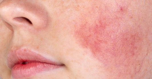 Which Face Wash Is Best For Sensitive Skin?