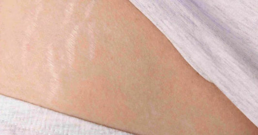 How To Apply Bio Oil For Stretch Marks?