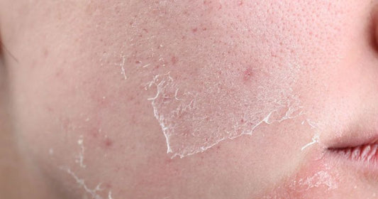 How To Get Rid of Dead Skin Without Exfoliating?