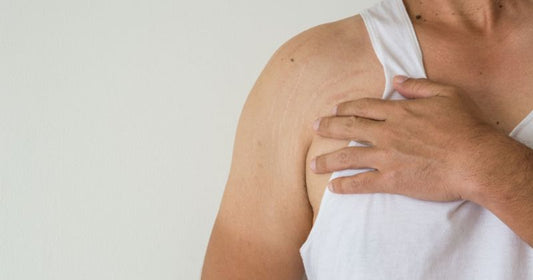 How To Hide Stretch Marks on Arms?