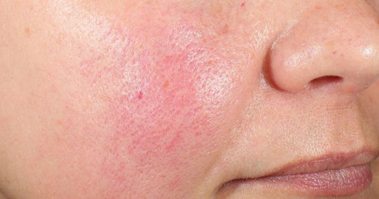 How To Improve The Skin Barrier? Top 10 Ways Listed.