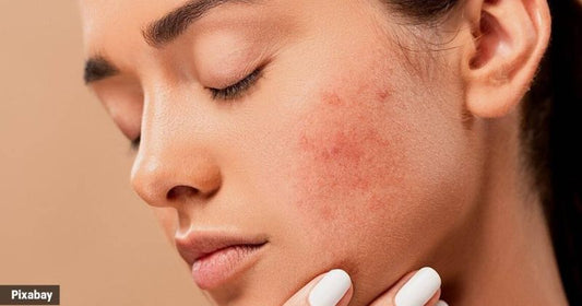How To Reduce Skin Inflammation And Redness?