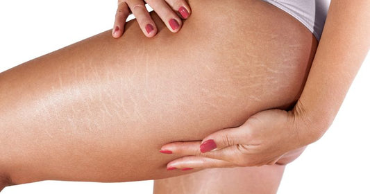 How To Remove Stretch Marks on Thighs?