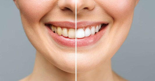 What Can You Eat After Whitening Your Teeth?