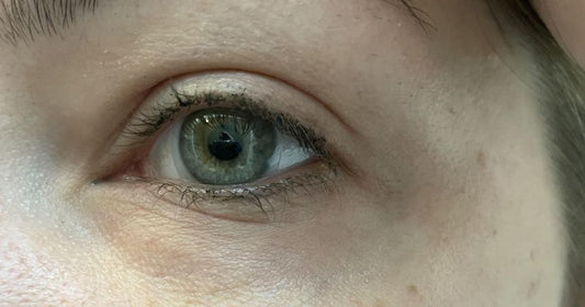 What Causes Yellowing of The Skin Around The Eyes?