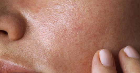 Which Facial Is Good For Oily Skin?