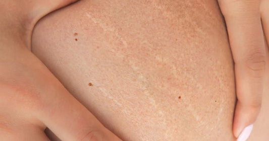Which Oil Is Best For Stretch Marks During Pregnancy?