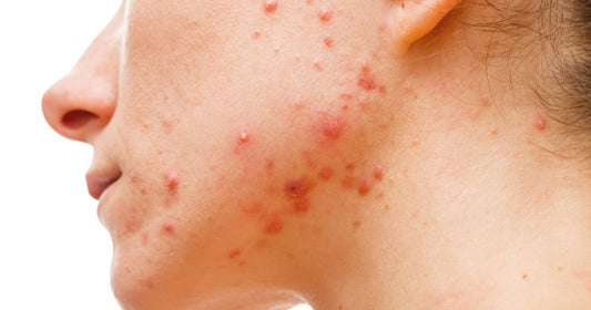 Which Is The Best Face Wash For Acne Prone Skin In India?