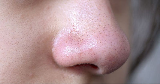 How To Remove Blackheads With Toothpaste?