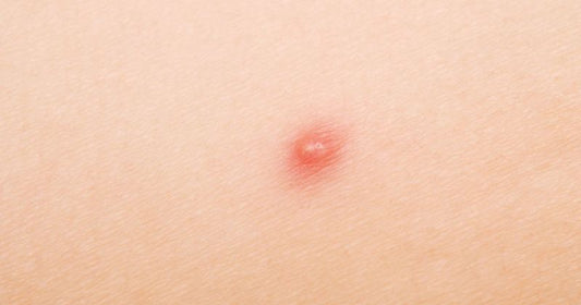 Let's Find Best Soaps In India For Treating Pimples, Interested?