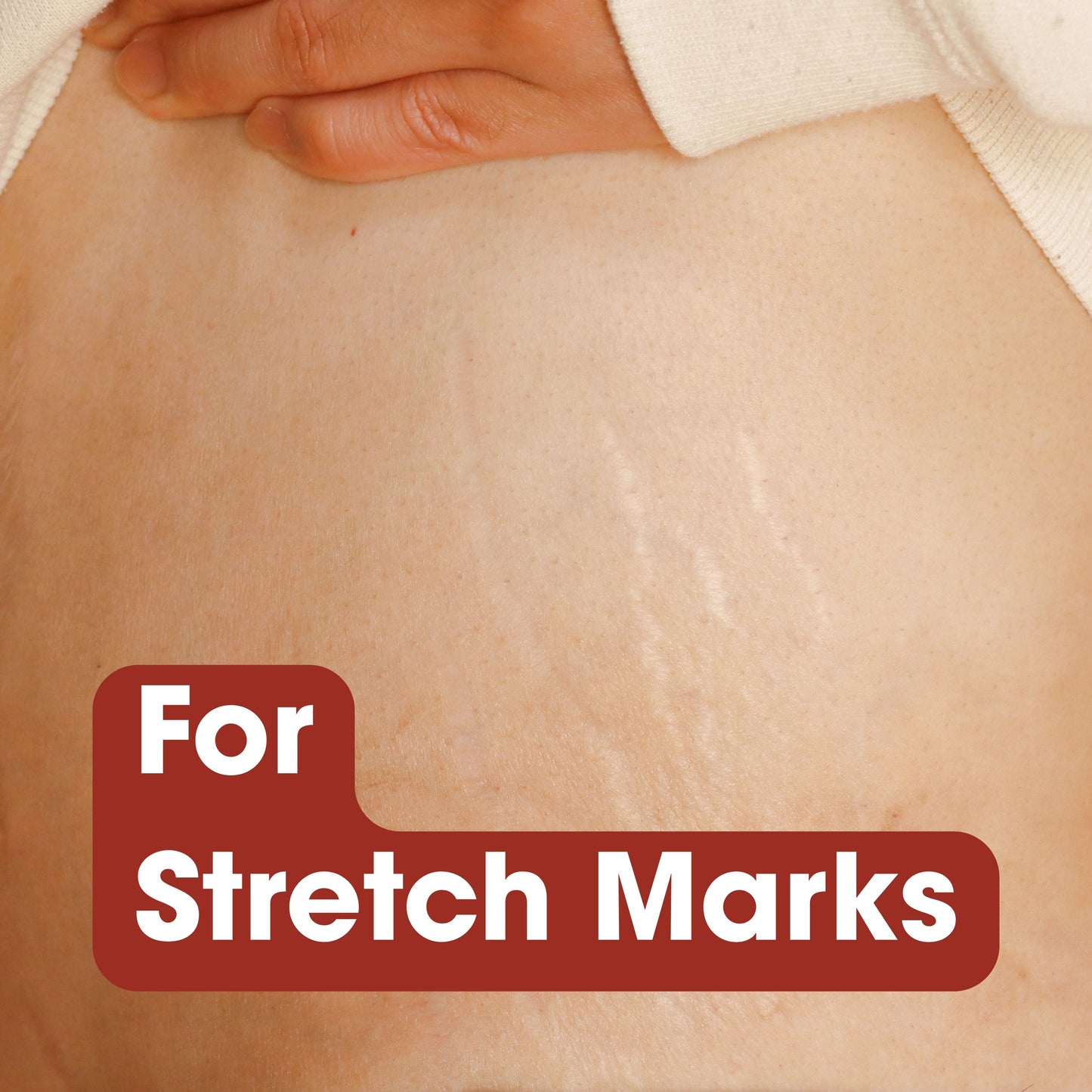 Stretch Marks Oil